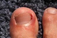 Signs You May Have an Ingrown Toenail