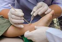 Why Are Diabetics More Susceptible to Foot Wounds?