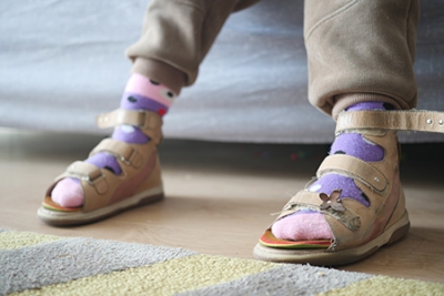 How Insoles Help Children with Flexible Flatfoot