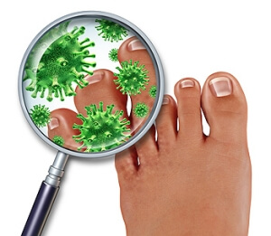 What Causes Athlete’s Foot?