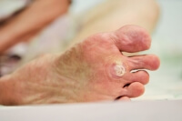 What Type of Virus Causes Plantar Warts?