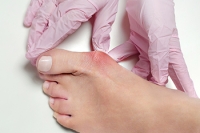 Common Symptoms of Bunions