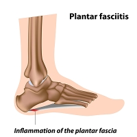 Possible Causes of Plantar Fasciitis