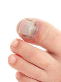 Possible Treatment of a Broken Toe