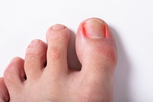 Ingrown Toenail Management