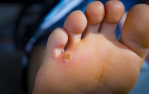 Surgical Treatment of Corns