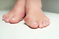 Bunions and Bunionettes