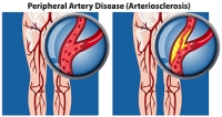 Understanding the Risks of PAD