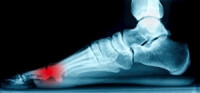 Where Are the Sesamoid Bones Located?