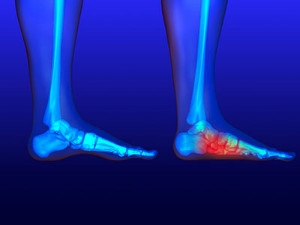 Supportive Shoes May Help Flat Feet