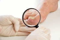 How Fungal Toenail Infections Occur
