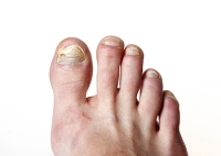 What Caused My Toenail to Become Discolored?