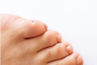 Can Corns on the Feet Become Serious Problems?