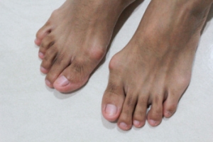 Relieving the Discomfort of Bunions