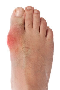 What Causes Gout?