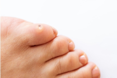 Causes and Risk Factors of Corns