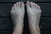 What Causes a Tailor’s Bunion?